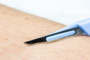 Clinical Challenges: Skin Cancer Excisions in General Practice image