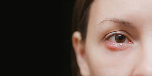 Hot Topics Webinar: Hip Pain, Acute Diverticulitis and Recurrent Blepharitis image