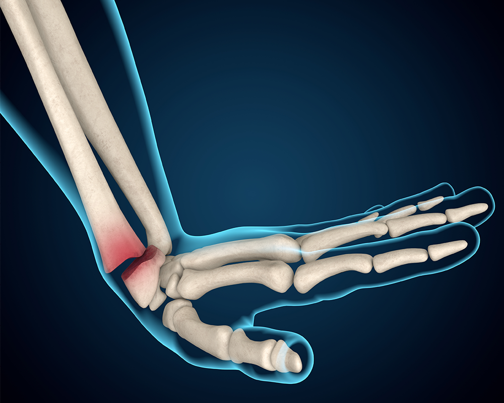 Wrist Fracture Clinical Update Medcast
