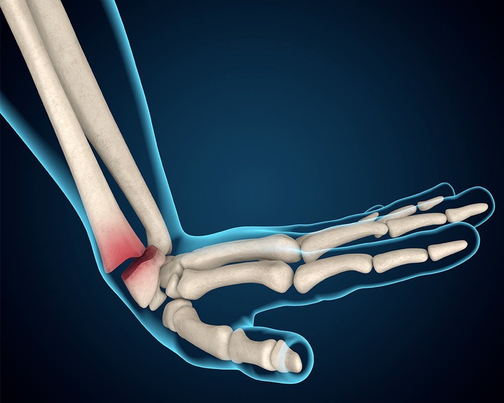 wrist-fracture-clinical-update-medcast