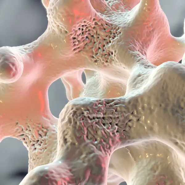 Osteoporosis: a case-based approach to secondary fracture prevention tile image